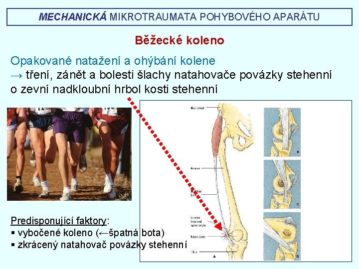 MECHANICKÁ MIKROTRAUMATA POHYBOVÉHO APARÁTU Běžecké koleno Opakované natažení a ohýbání kolene → tření, zánět