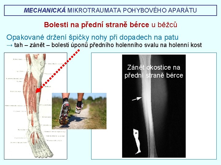 MECHANICKÁ MIKROTRAUMATA POHYBOVÉHO APARÁTU Bolesti na přední straně bérce u běžců Opakované držení špičky