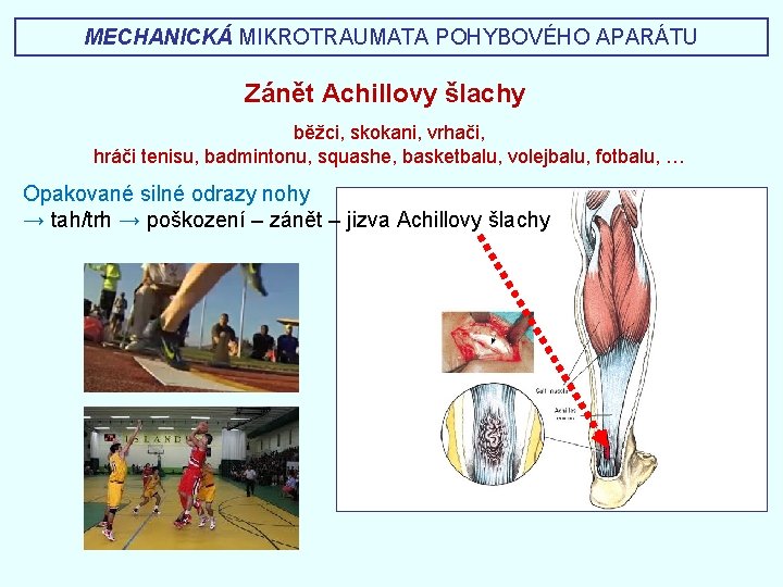 MECHANICKÁ MIKROTRAUMATA POHYBOVÉHO APARÁTU Zánět Achillovy šlachy běžci, skokani, vrhači, hráči tenisu, badmintonu, squashe,