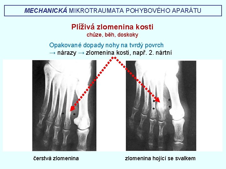 MECHANICKÁ MIKROTRAUMATA POHYBOVÉHO APARÁTU Plíživá zlomenina kosti chůze, běh, doskoky Opakované dopady nohy na