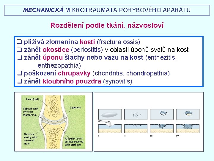 MECHANICKÁ MIKROTRAUMATA POHYBOVÉHO APARÁTU Rozdělení podle tkání, názvosloví q plíživá zlomenina kosti (fractura ossis)