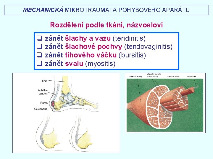 MECHANICKÁ MIKROTRAUMATA POHYBOVÉHO APARÁTU Rozdělení podle tkání, názvosloví q zánět šlachy a vazu (tendinitis)