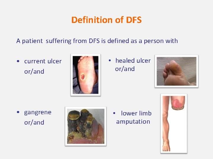 Definition of DFS A patient suffering from DFS is defined as a person with
