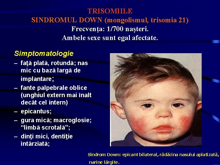 TRISOMIILE SINDROMUL DOWN (mongolismul, trisomia 21) Frecvenţa: 1/700 naşteri. Ambele sexe sunt egal afectate.