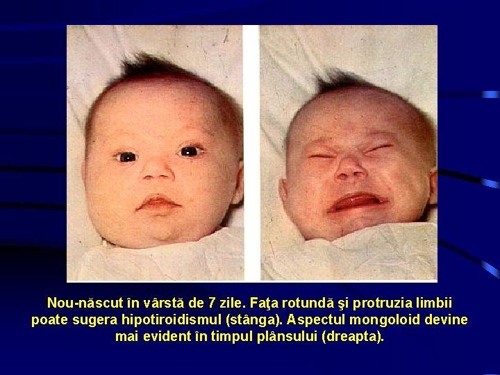 Nou-născut în vârstă de 7 zile. Faţa rotundă şi protruzia limbii poate sugera hipotiroidismul