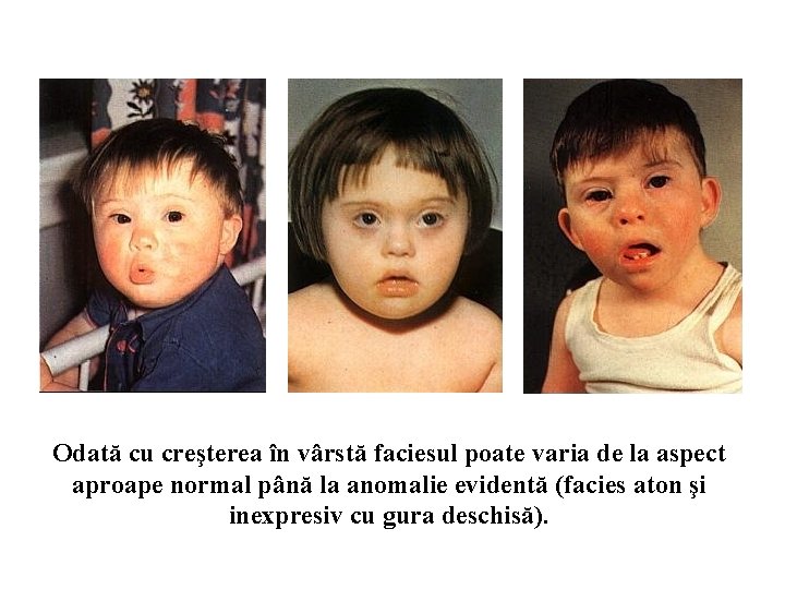 Odată cu creşterea în vârstă faciesul poate varia de la aspect aproape normal până