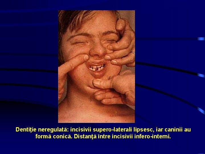 Dentiţie neregulată: incisivii supero-laterali lipsesc, iar caninii au formă conică. Distanţă între incisivii infero-interni.