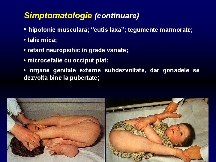Simptomatologie (continuare) • hipotonie musculară; “cutis laxa”; tegumente marmorate; • talie mică; • retard