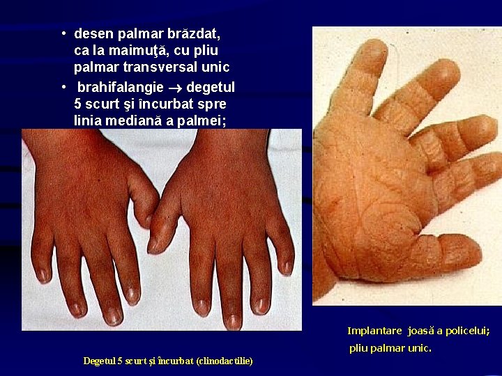  • desen palmar brăzdat, ca la maimuţă, cu pliu palmar transversal unic •