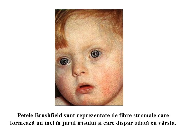 Petele Brushfield sunt reprezentate de fibre stromale care formează un inel în jurul irisului