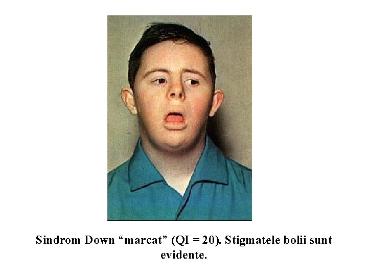 Sindrom Down “marcat” (QI = 20). Stigmatele bolii sunt evidente. 