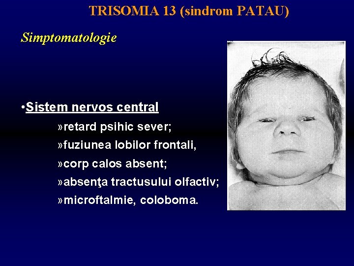 TRISOMIA 13 (sindrom PATAU) Simptomatologie • Sistem nervos central » retard psihic sever; »