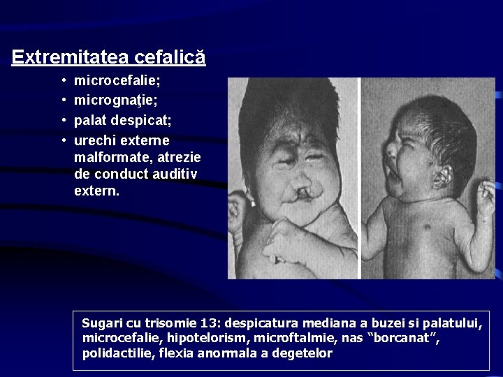Extremitatea cefalică • • microcefalie; micrognaţie; palat despicat; urechi externe malformate, atrezie de conduct