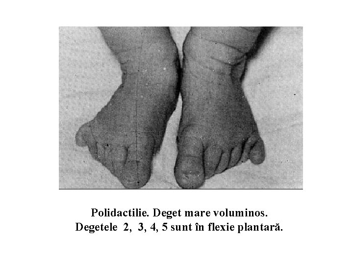 Polidactilie. Deget mare voluminos. Degetele 2, 3, 4, 5 sunt în flexie plantară. 