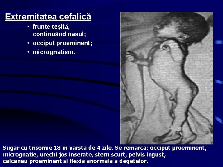 Extremitatea cefalică • frunte teşită, continuând nasul; • occiput proeminent; • micrognatism. Sugar cu