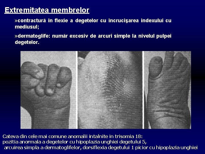 Extremitatea membrelor » contractură în flexie a degetelor cu încrucişarea indexului cu mediusul; »