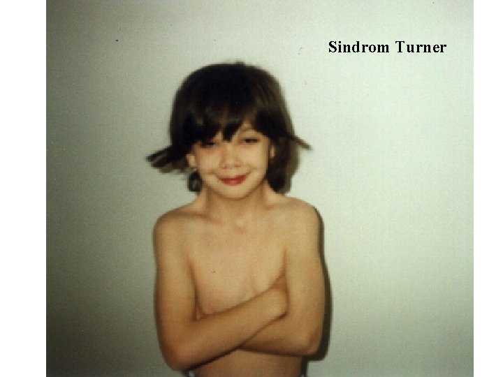 Sindrom Turner 