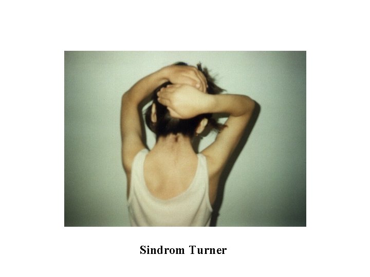 Sindrom Turner 