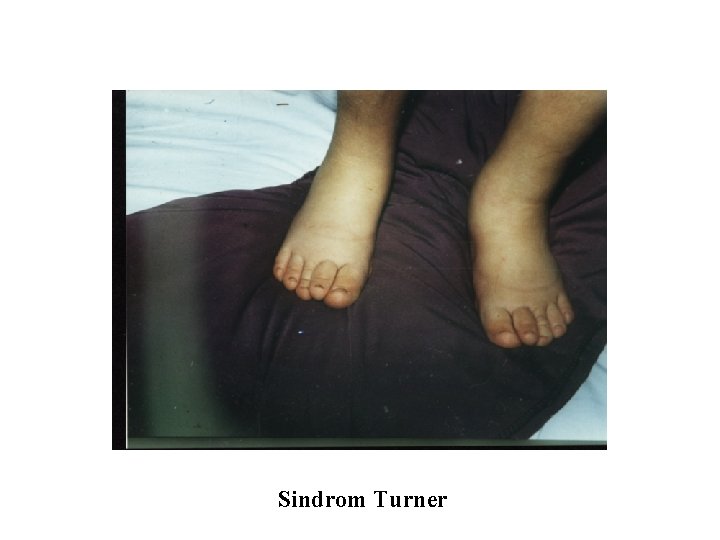 Sindrom Turner 