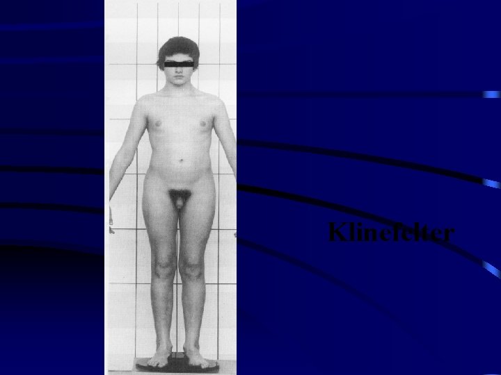 Klinefelter 