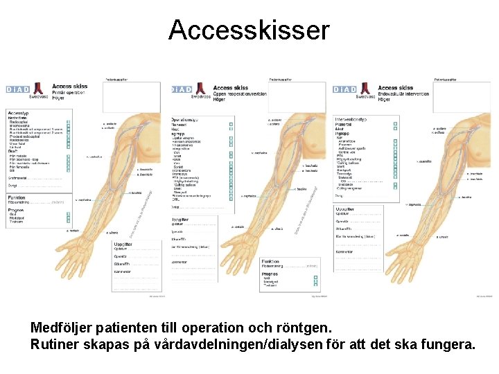 Accesskisser Medföljer patienten till operation och röntgen. Rutiner skapas på vårdavdelningen/dialysen för att det