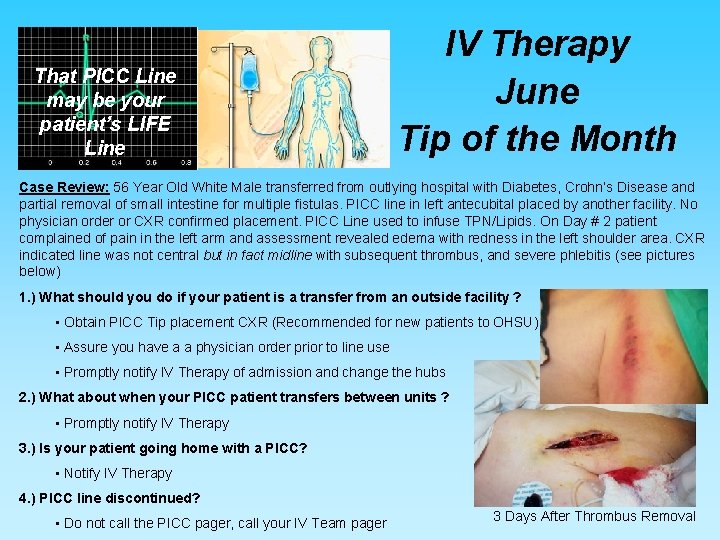That PICC Line may be your patient’s LIFE Line IV Therapy June Tip of