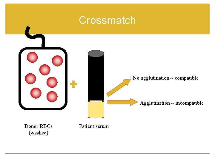 Crossmatch No agglutination ~ compatible Agglutination ~ incompatible Donor RBCs (washed) Patient serum 