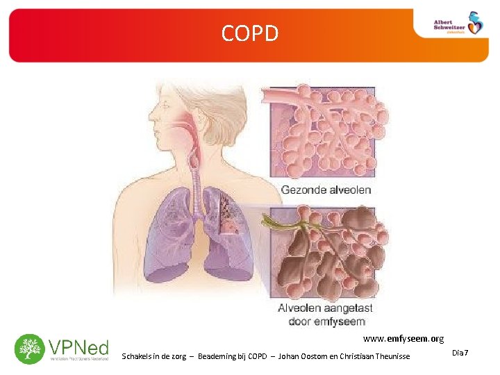 COPD www. emfyseem. org Schakels in de zorg – Beademing bij COPD – Johan