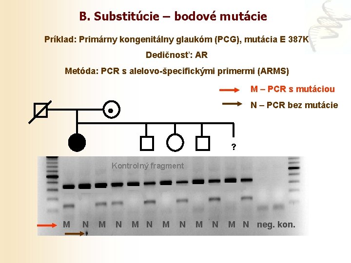 B. Substitúcie – bodové mutácie Príklad: Primárny kongenitálny glaukóm (PCG), mutácia E 387 K