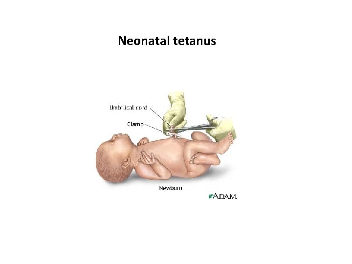 Neonatal tetanus 