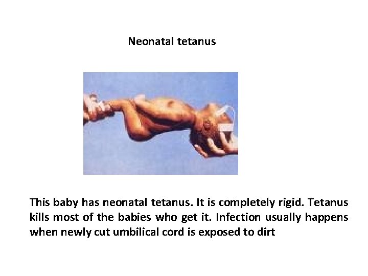 Neonatal tetanus This baby has neonatal tetanus. It is completely rigid. Tetanus kills most