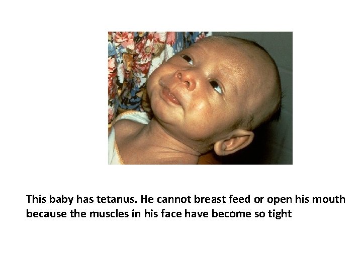 This baby has tetanus. He cannot breast feed or open his mouth because the