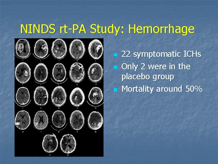 NINDS rt-PA Study: Hemorrhage n n n 22 symptomatic ICHs Only 2 were in