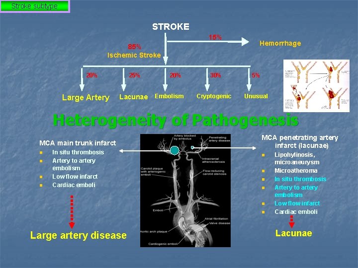 Stroke subtype STROKE 15% 85% Ischemic Stroke 20% Large Artery 25% Lacunae 20% Embolism