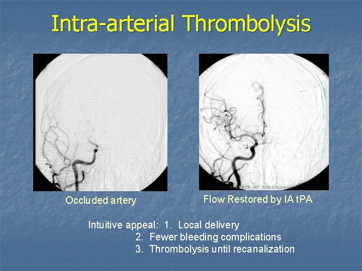 Intra-arterial Thrombolysis Occluded artery Flow Restored by IA t. PA Intuitive appeal: 1. Local