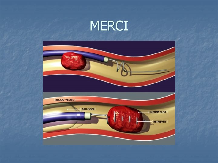 MERCI 