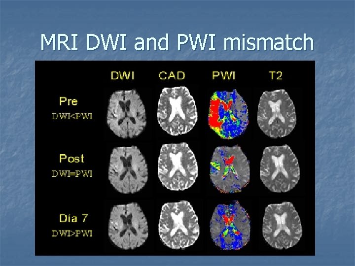 MRI DWI and PWI mismatch 