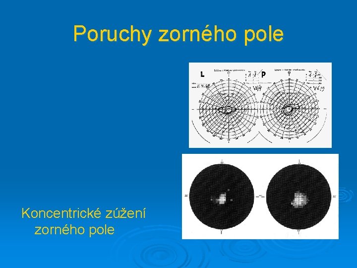Poruchy zorného pole Koncentrické zúžení zorného pole 