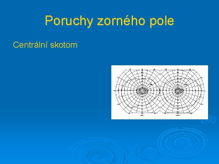 Poruchy zorného pole Centrální skotom 