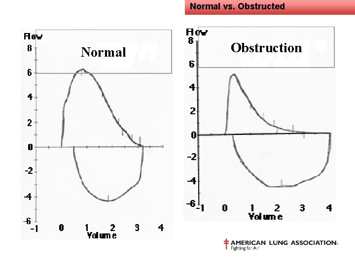 Normal vs. Obstructed Normal Obstruction 