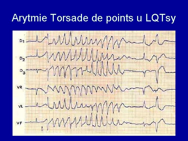 Arytmie Torsade de points u LQTsy 