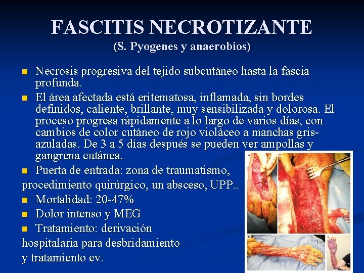 FASCITIS NECROTIZANTE (S. Pyogenes y anaerobios) Necrosis progresiva del tejido subcutáneo hasta la fascia