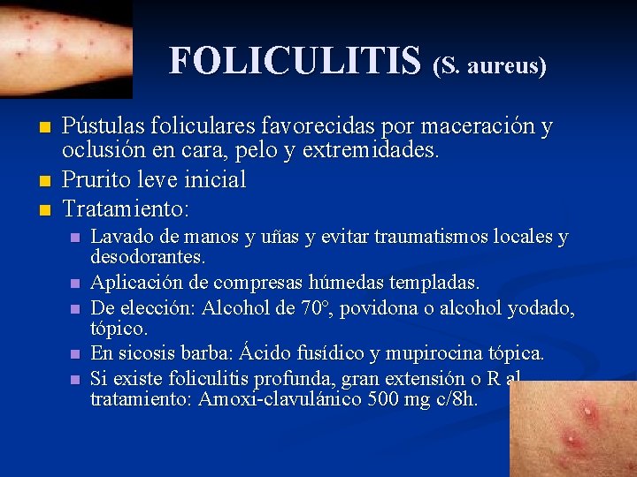 FOLICULITIS (S. aureus) n n n Pústulas foliculares favorecidas por maceración y oclusión en