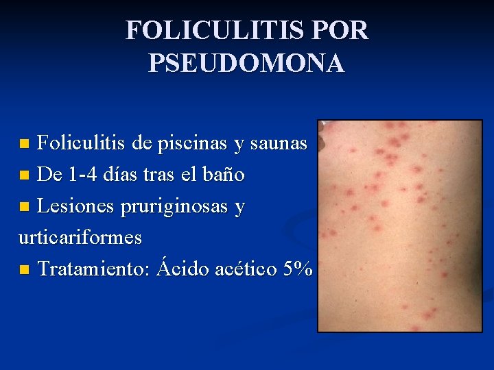 FOLICULITIS POR PSEUDOMONA Foliculitis de piscinas y saunas n De 1 -4 días tras