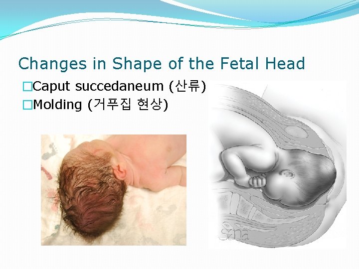 Changes in Shape of the Fetal Head �Caput succedaneum (산류) �Molding (거푸집 현상) 