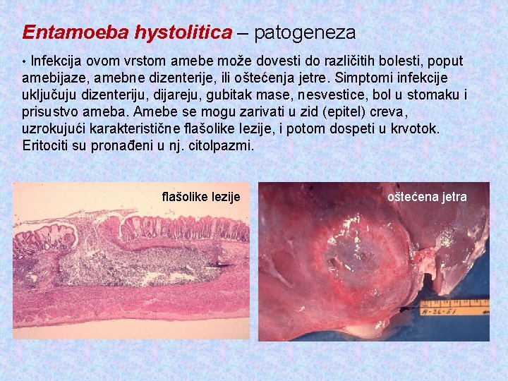 Entamoeba hystolitica – patogeneza • Infekcija ovom vrstom amebe može dovesti do različitih bolesti,