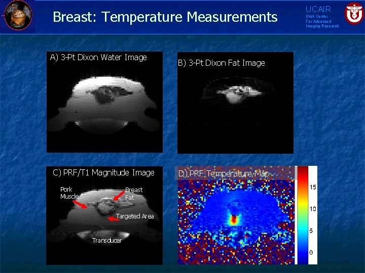 Breast: Temperature Measurements A) 3 -Pt Dixon Water Image C) PRF/T 1 Magnitude Image