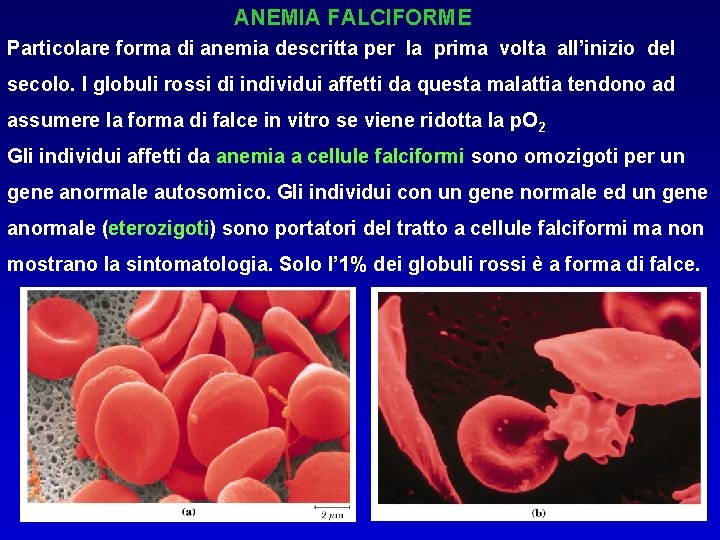 ANEMIA FALCIFORME Particolare forma di anemia descritta per la prima volta all’inizio del secolo.