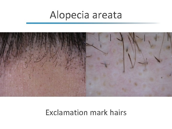 Alopecia areata Exclamation mark hairs 