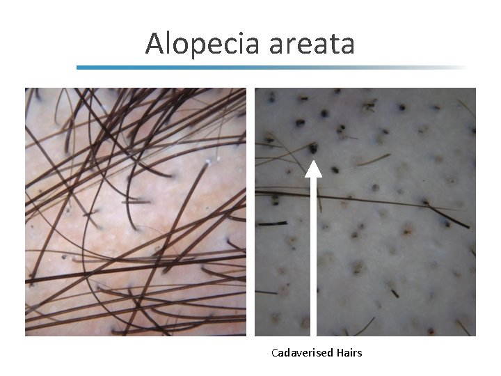 Alopecia areata Cadaverised Hairs 